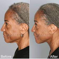 facial cosmetic surgery