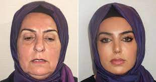 turkish plastic surgery