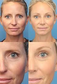 endoscopic brow lift cost