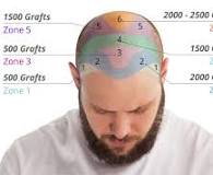 hairline transplant cost