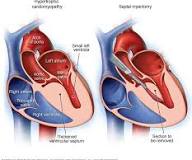 myectomy