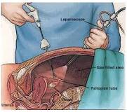 laparoscopic surgery
