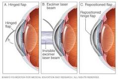 lasik eye surgery correction