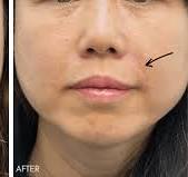 nasal filler