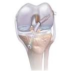 acl transplant