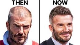david beckham hair implant