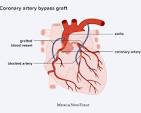 heart bypass surgery