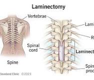 laminectomy