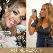 nose job rhinoplasty cost