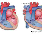cardiac valve replacement