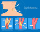 carotid artery endarterectomy