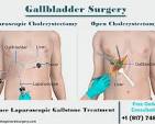 cholecystectomy surgery