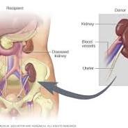 kidney transplants