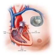 pacemaker surgery