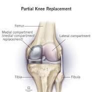 partial knee replacement