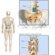 spinal fusion
