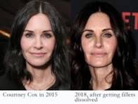 bad cheek fillers