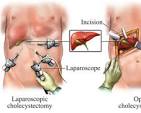 gallbladder surgery