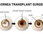 cornea transplant